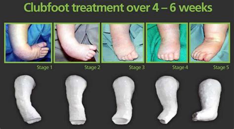 Ponseti Technique for the Management of Congenital Talipes 